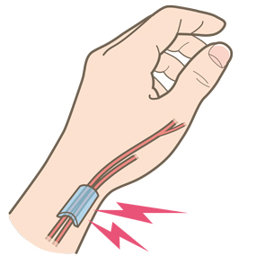 腱鞘に炎症を起こした際のイメージ画像